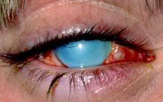 Виды ожогов глаз и лечение