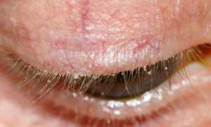 Симптомы демодекоза и особенности питания при заболевании
