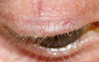 Симптомы демодекоза и особенности питания при заболевании