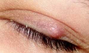 Халязион как осложнение от ячменя, лечение патологии