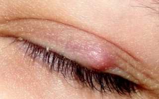 Халязион как осложнение от ячменя, лечение патологии