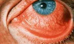 Конъюнктивит без нагноения, лечение и возможные осложнения