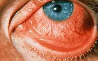 Конъюнктивит без нагноения, лечение и возможные осложнения