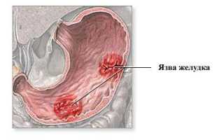 Почему болит живот после употребления алкоголя, что делать в этом случае