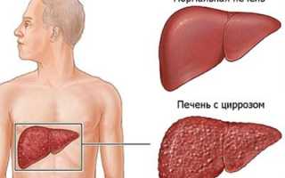Как восстановить печень после алкогольной интоксикации