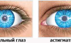 Особенности близорукости и астигматизма