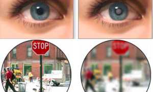 Классификация и особенности незрелой катаракты