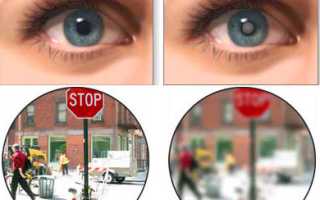 Классификация и особенности незрелой катаракты