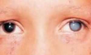 Симптомы глаукомы у детей, лечение и проффилактика появления