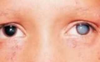 Симптомы глаукомы у детей, лечение и проффилактика появления