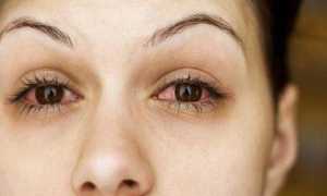 Как лечить затянувшийся конъюнктивит