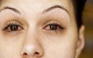 Как лечить затянувшийся конъюнктивит