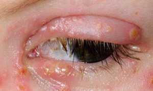 Герпес на глазу, особенности лечения