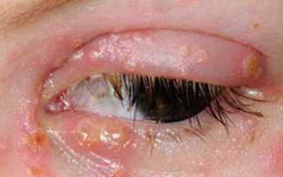 Герпес на глазу, особенности лечения