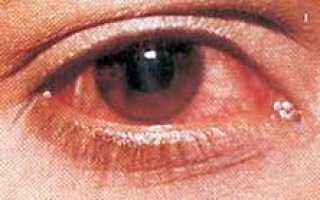 В чем отличие бактериального конъюнктивита от вирусного
