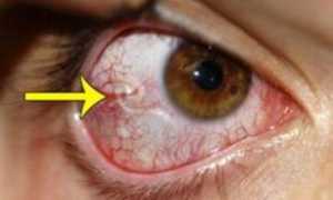 При каких заболеваниях в глазах появляются паразиты