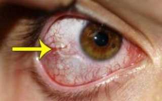 При каких заболеваниях в глазах появляются паразиты