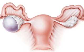 Пароовариальные кисты яичника: все, что нужно знать пациентке