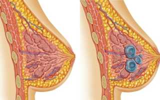Инвазивная протоковая карцинома молочной железы