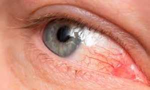 Причины такого заболевания как конъюнктивит