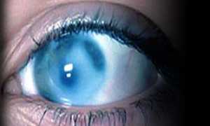 Лечение катаракты с помощью народной медицины