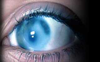 Лечение катаракты с помощью народной медицины