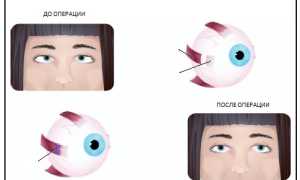 Особенности медикаментозного лечения косоглазия