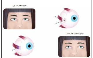 Особенности медикаментозного лечения косоглазия