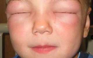 Передозировка зиртеком у детей