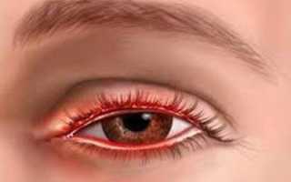 Эффективные методы лечения воспаленных глаз