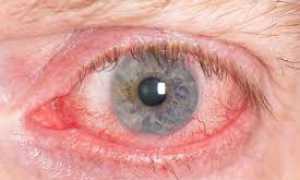 Гиперемия глаз: причинные факторы