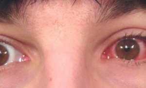 Виды конъюнктивитов у взрослых и способы их лечения