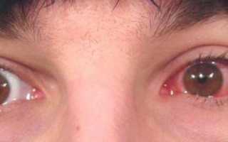 Виды конъюнктивитов у взрослых и способы их лечения