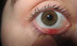 Виды халязиона у ребенка, лечение воспаления