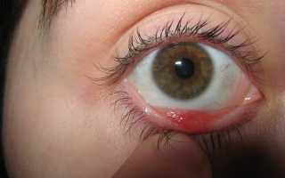 Виды халязиона у ребенка, лечение воспаления