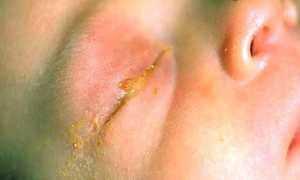 Гнойный конъюнктивит у ребенка: лечение, диагностика