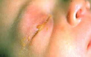 Гнойный конъюнктивит у ребенка: лечение, диагностика