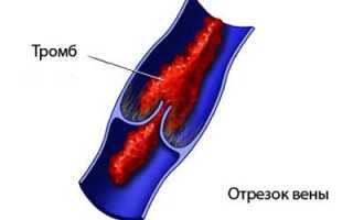 Как проявляется отравление варфарином и его последствия