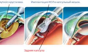 Факоэмульсификация катаракты, возможные осложнения