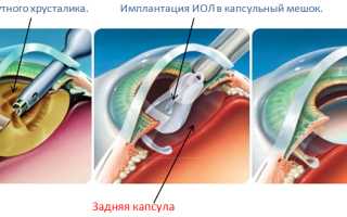 Факоэмульсификация катаракты, возможные осложнения