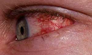 Из-за чего могут возникать покраснения глаз?