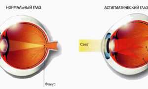 Коррекция астигматизма с помощью операции
