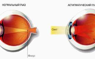 Коррекция астигматизма с помощью операции