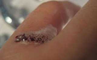 Польза и вред перекиси водорода