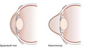 Кератоконус глаз, причины по которым проявляется заболевание