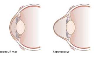Кератоконус глаз, причины по которым проявляется заболевание
