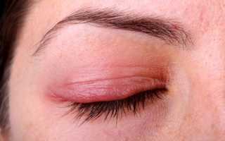 Чешуйчатый вид блефарита