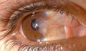 Причина появление пингвекулы на глазу