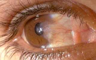Причина появление пингвекулы на глазу