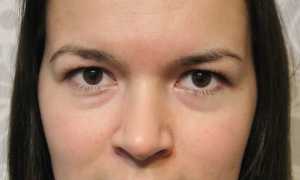 От каких заболеваний возникают отеки под глазами?